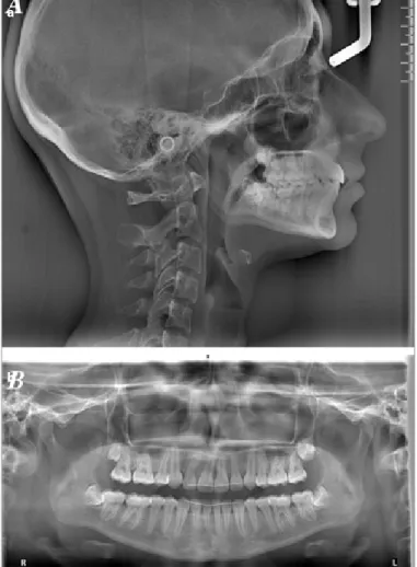 Figure 7. Cephalometric superimposition.