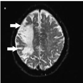 Figure 1 - Cerebral and diffusion MRI showing acute infarction in the 