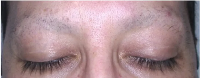Figure 1. Eyebrow trichotillomania. Almost complete loss of eye-