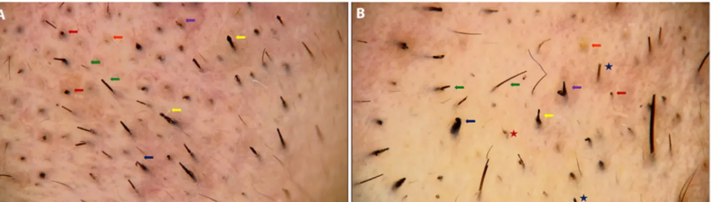 Figure 2. Trichoscopic features of eyebrow trichotillomania. (A) Black dots (red arrows), broken hairs at different lengths (green arrows), 