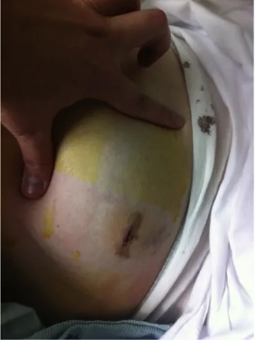 Fig. 1. Distended abdomen, tense/hard in right lower quadrant (RLQ) and with nodular mass noted on her initial physical examination.