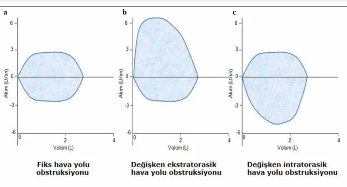 Şekil 10. a-c. Üst havayolu obstrüksiyonunun lokalizasyonuna göre akım-volüm halkasınde görülebilecek değişiklikler, (a) fiks obstrüksiyon, 