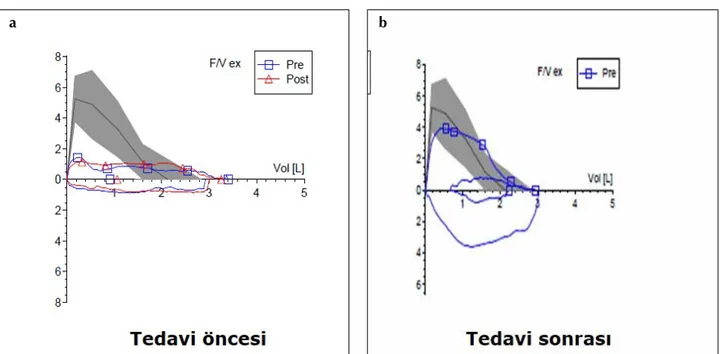 Şekil 11. a, b. Larinks ödemi nedeniyle sabit üst havayolu obstrüksiyonu olan bir olgunun (a) tedavi öncesi ve (b) tedavi sonrası akım-volüm 