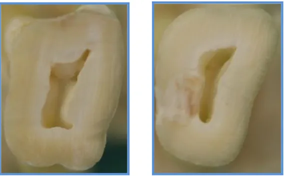 Şekil 4.3 Oval şekilli pulpa tabanı