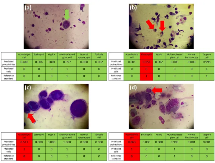 Figure 3.  TzanckNet predictions and the corresponding reference standards for four selected images