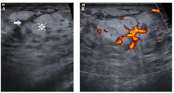 Figure 1. A, B-mode US image showing ill-defined hyperechoic lesions (star) including finger-like hypoechoic areas (arrow) classified as BI-RADS 3; B, Power Doppler image showing increased Doppler flow within the lesion.