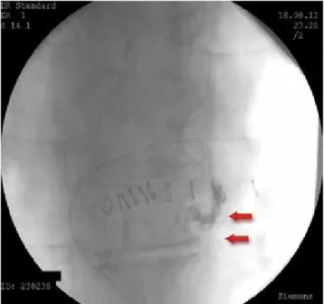 Figure 2. Distribution of the radioopaque that is given through  the paravertebral catheter.