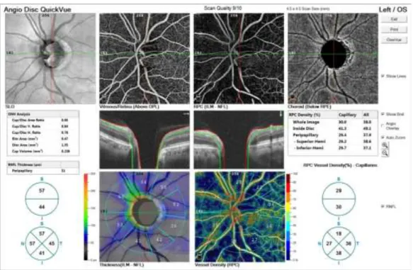 Şekil 3.4. Şekil 3.3’te sağlıklı gözü izlenen bireyin glokomdan etkilenmiş gözünün disk  OKT-A görüntüsü