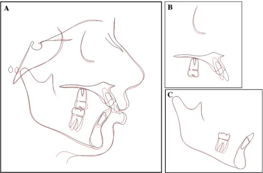 Fig 7. A, Pink spot under the gingival margin of upper left central incisor; B, periapical radiograph taken for  prelimi-nary examination.