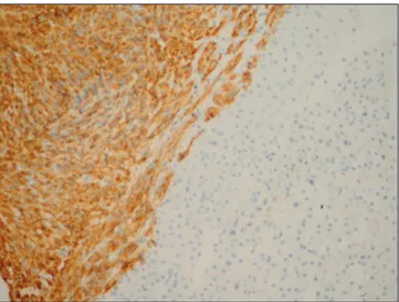 Figure 2. DOG 1 negative in lymphoid cells in lymph node, while 