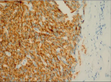 Figure 5. DOG1-positive tumor areas in breast