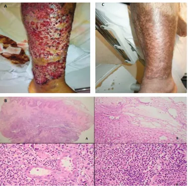 Figure  1. A) A giant ulcer greater than 20 cm in size with an irregular  margin and tender and hyperemic skin changes arising adjacent  to  the  ulcer
