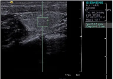 Figure 1a. Shear wave velocity (2.47 m/s) of a 42-year-old woman with 