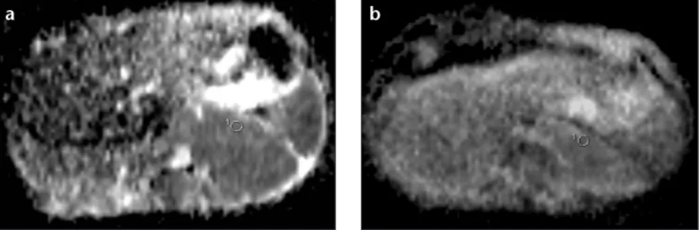 Figure 2. a, b. An example of a region-of-interest drawn on an ADC map of a 