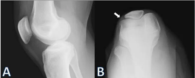 Figure 2: This is a preoperative MRI of the right knee. Axial (A) and coronal (D) T1-weighted pre-contrast images show 