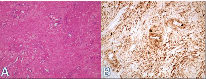 Figure 3: The tumor is composed of well-differentiated smooth muscle cells and blood vessels ((A), H&amp;E; 200)
