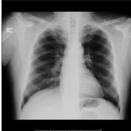 Figure 2: Sarcoidosis granulomas are noncaseating granuloma, containing 