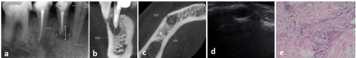 Figure 2  (a) Periapical radiography of a patient from Group A. Representative width and height measurements of a periapical granuloma  related to right mandibular first premolar tooth