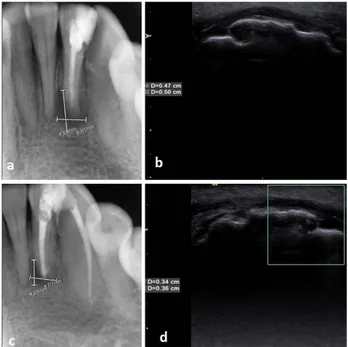 Figure 3  (a) Pre-operative periapical radiography of a patient from group B. Representative maximum width and height measurement of a peria- peria-pical lesion related to right mandibular first premolar tooth