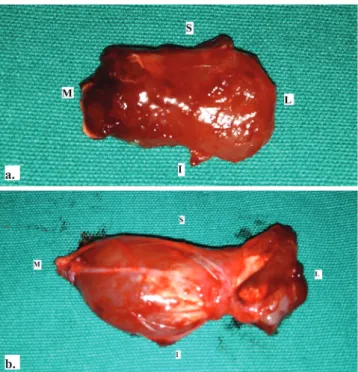 Fig. 1.  External view of t he temporal muscle (a), the superficial  and deep parts of the masseter muscle (b)  separated from the  surrounding tissue (I inferior, S superior, M medial,  L lateral)