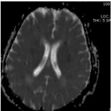 Figure 2. ADC map show multiple acute ischemic lesions in deep white matter re- re-gion of both cerebral hemispheres