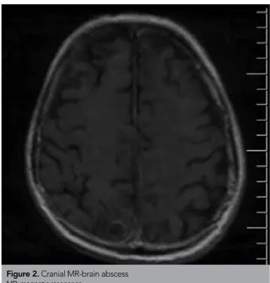 Figure 2. Cranial MR-brain abscess 