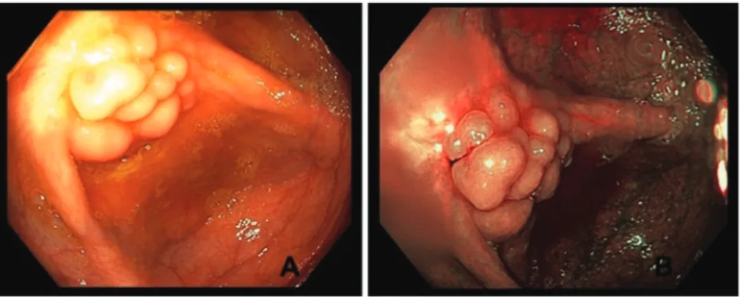 Figure 1: Endoscopic view of polypoid lesion completely covers appendix orifice on white light (A) and narrow band imaging (B).