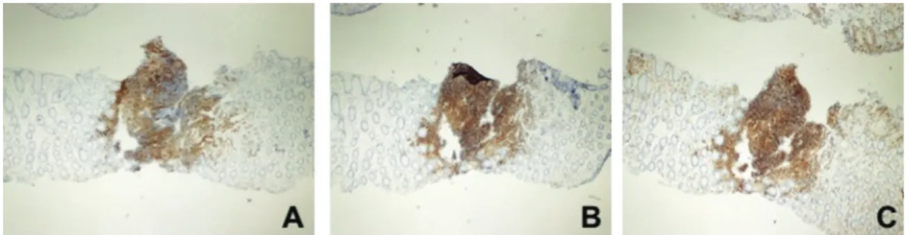 Figure 4: Immunohistochemical CD20 positivity (A), CD5 positivity (B) and CD43 positivity (C; ×40 original magnification).