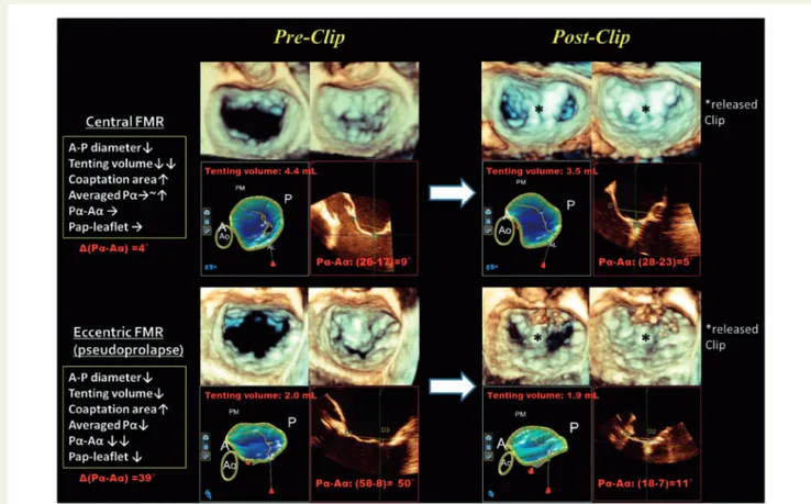 Figure 1 3D MV images and analyses pre- and post-clip. Compared with central FMR, eccentric FMR showed a greater improvement of asymmet- asymmet-rical tethering pattern but less prominent reduction of tenting volume