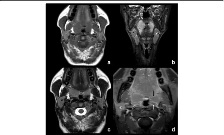 Fig. 1 Axial noncontrast T1 (a), coronal STIR (b), Axial T2-weighted (c) and postgadolinium T1-weighted with fat saturation (d) MR images