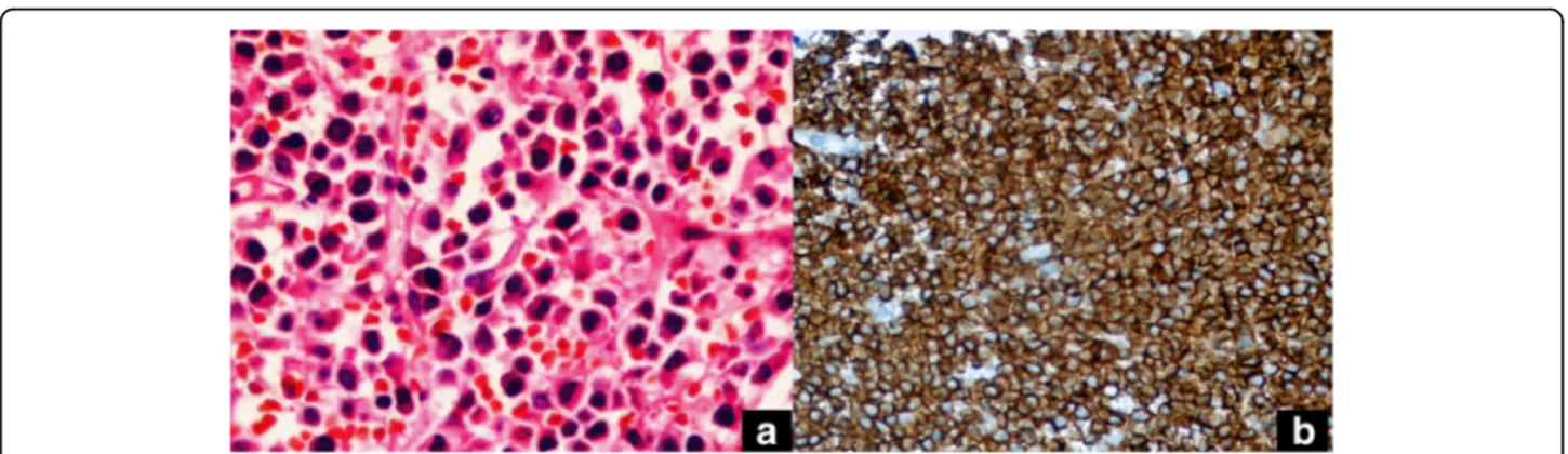 Fig. 2 Plasma cells with eccentric nucleus and abundant cytoplasm (hematoxylin eosin × 40) (a), Diffuse cytoplasmic, focal membranous CD138 staining on the plasma cells (streptavidinebiotin peroxidase × 400) (b)