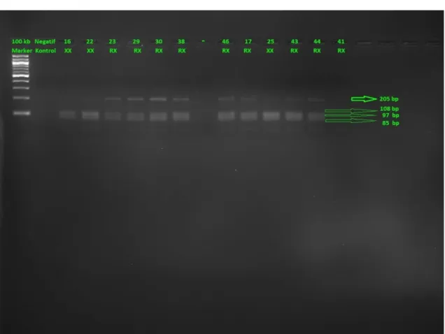 Şekil  4.2.  Atletizm  sporcularında  ACTN3  geni  DdeI  restriksiyon  enzimi  ile  kesim  sonucunda elde edilen jel görüntüsü