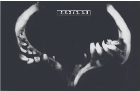 Fig. 5. Pharyngeal teeth of Barbus plebejus escherichi Steındachner, 1897  (5+3+2/2+3+5).