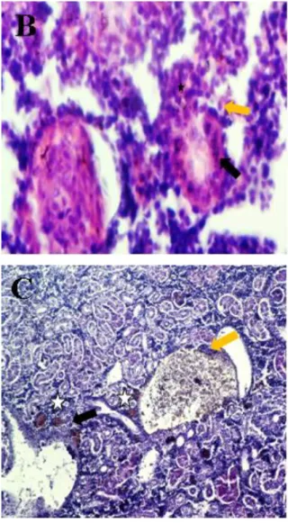 Şekil 5B.  Kidney tissue  exposed to 15 mg/L  nitrogen  fertilizer.  Vacuolar  degeneration  (orange arrow),  mononuclear  cell infiltration  (MHI)  (black  arrow)  and  Hyaline  cylinders  (star)