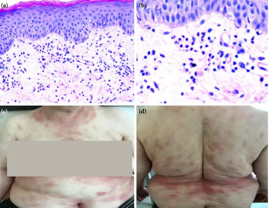 Figure 2.  (a, b) Erythematous plaques occurring on the same localizations after the second use  of gabapentin.
