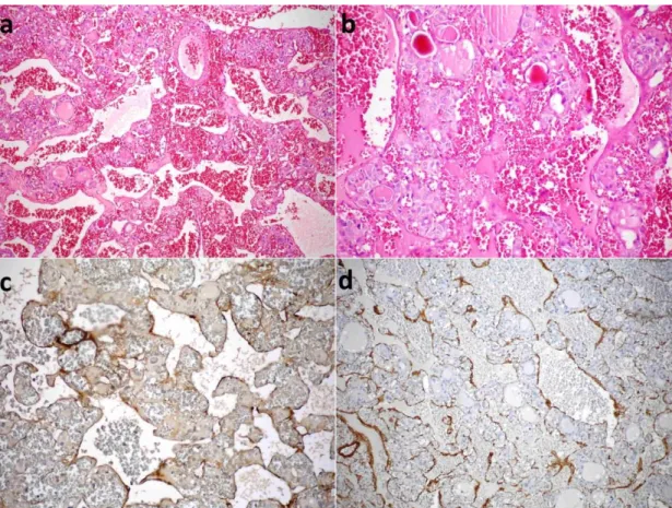 Figure 1: a, b) The tumor contains many cavernous thin-walled vessels, some of which are thrombosed (H&amp;E,  x100; H&amp;E, x200)