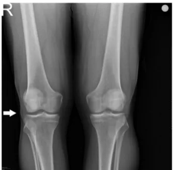 Figure 1. Soft tissue edema in the patient’s right knee