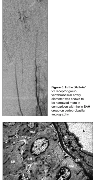 Figure 4: Vertebrobasilar  angiography in 