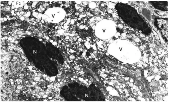 Figure 3.  Electron micrograph of  the  thyroid tissue of  the  methamidophos-treated  rats (group 1) showing vacuoles filled with fine granular material (V) in the  cytoplasm  of follicular  cells (Fc) and indented heterochromic  nuclei (N) (uranyl  aceta