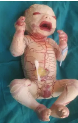 Figure 1. The first pictures after birth of the newborn with Harlequin 