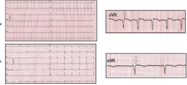 Fig. 2. Typical AVNRT and normal sinus rhythm after conversion via overdrive pacing in our EPS study