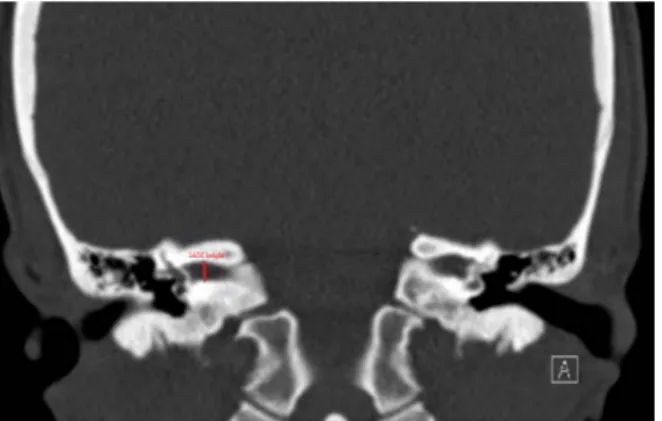 Figure 2. The width and length measurements of  the internal acoustic meatus IAM:  Internal  acoustic meatus 