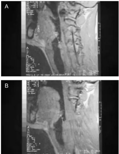 FIGURE 2. MRI of a female participant in the control group shows ( A) the measurement of the right lateral thyrohyoid ligament and ( B) the measurement of the left lateral thyrohyoid ligament.