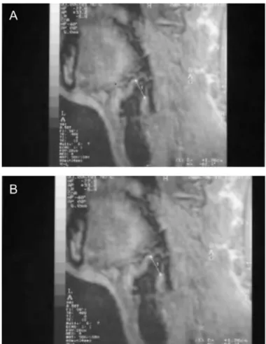 FIGURE 4. MRI of a female participant in Group I shows ( A) the measurement of the right lateral thyrohyoid ligament and ( B) the measurement of the left lateral thyrohyoid ligament.