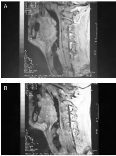 FIGURE 6. MRI of a female participant in Group II shows ( A) the measurement of the right lateral thyrohyoid ligament and ( B) the measurement of the left lateral thyrohyoid ligament.