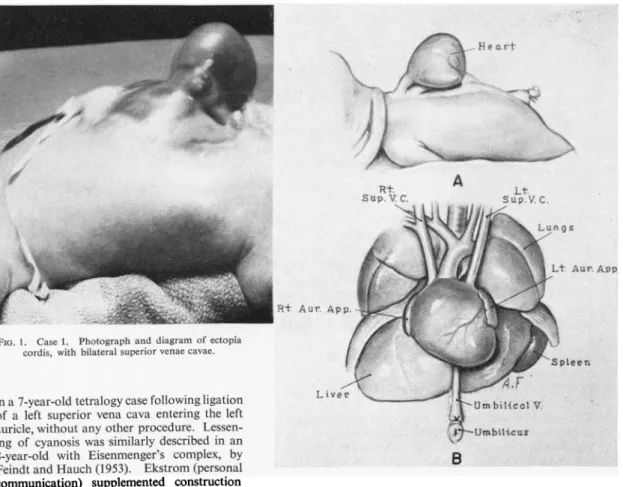 FIG. 1. Case 1. Photograph and diagram of ectopia