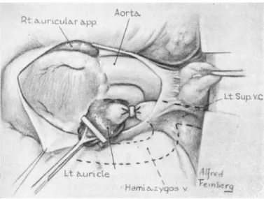 FIG. 2. Case 3. Intrapericardial ligation of left superior vena cava. Note large hemiazygos entering left superior vena cava 