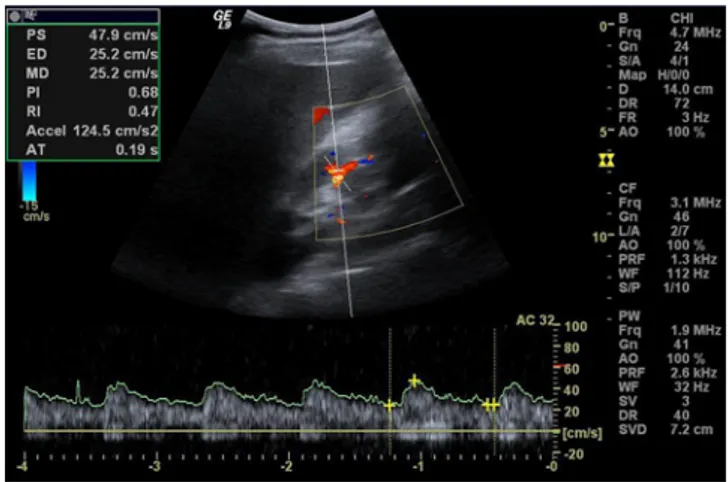 Fig. 1 Color duplex sonogram of a patient showing spectral Doppler findings (angle correction was performed in all measurements)