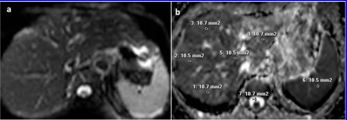 Figure 1 Diffusion-weighted MR image of the liver (b5600): (a) Liver apparent diffusion coefficient (ADC) map and (b) Segments of the liver, cerebrospinal fluid and spleen ROI.