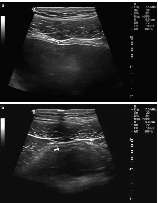 Figure 1. a, b. Ultrasound measurements of detrusor wall thickness (DWT). Between the  mucosa and adventitia (i.e., hyperechogenic lines), the detrusor was seen and measured  (a, arrow)